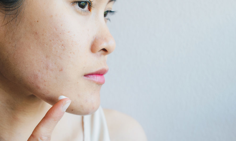 Acne-Treatment-Skin-Clinic-Feature-Image-1 Acne Treatment Skin Clinic Feature Image 1