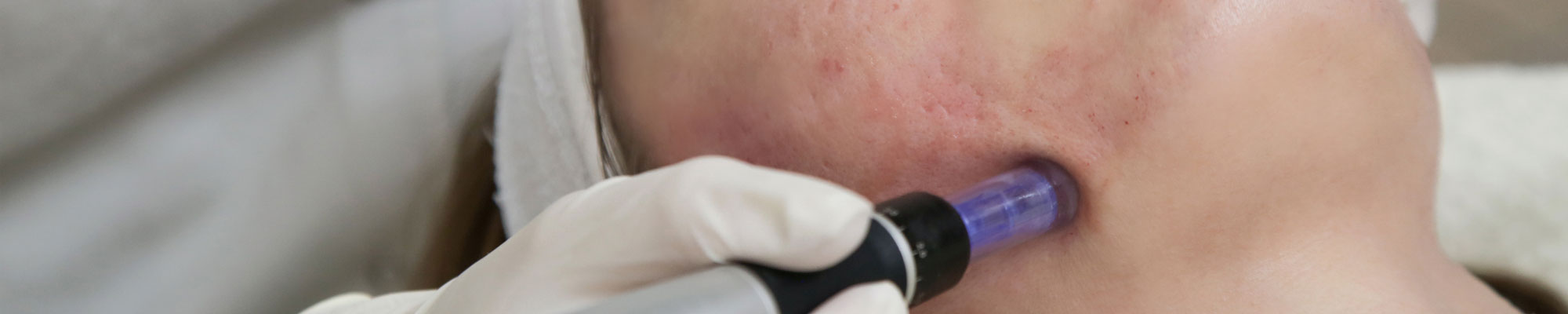 Acne-Treatment-Skin-Clinic-Main-Feature-Image Acne Treatment Skin Clinic Feature Main Image