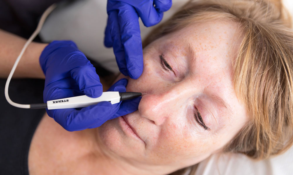 Advanced-Electrolysis-Feature-Image-1 electrolysis treatment image 1