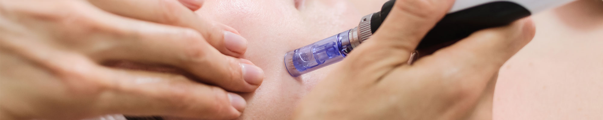 Microneedling-Skin-Clinic-Main-Feature-Image Microneedling Skin Clinic Main Feature Image