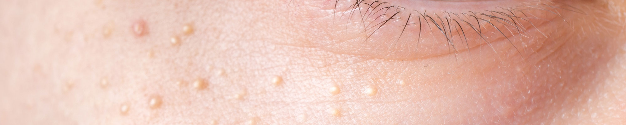 Milia and Milia Treatment Milia Removal Main Feature Image