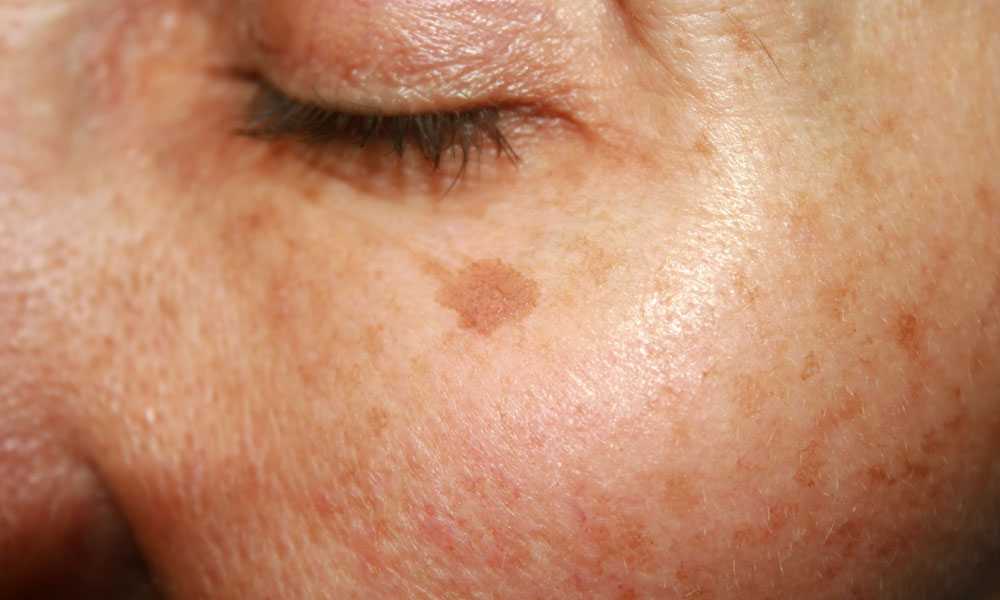 Pigmentation-Treatment-Age-Spot-Treatment-Feature-Image-1 Pigmentation Treatment Age Spot Treatment Feature Image 1