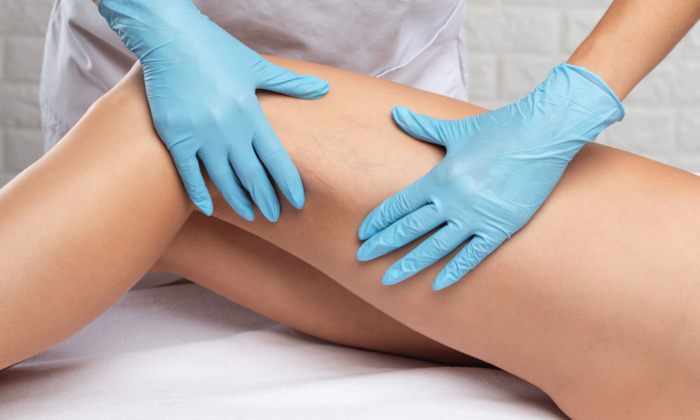 Sclerotherapy Feature Image 2
