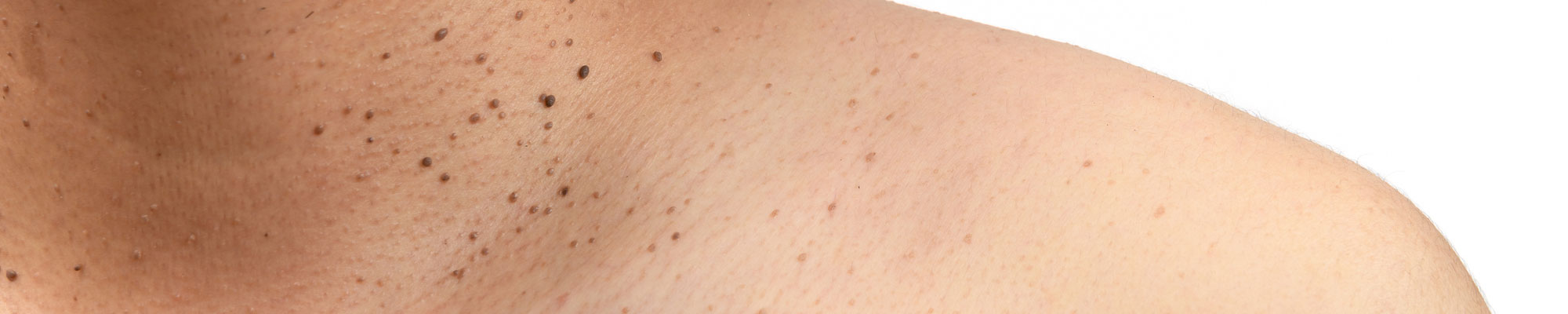 Skin Tag Removal Skin Consultation Main Feature Image