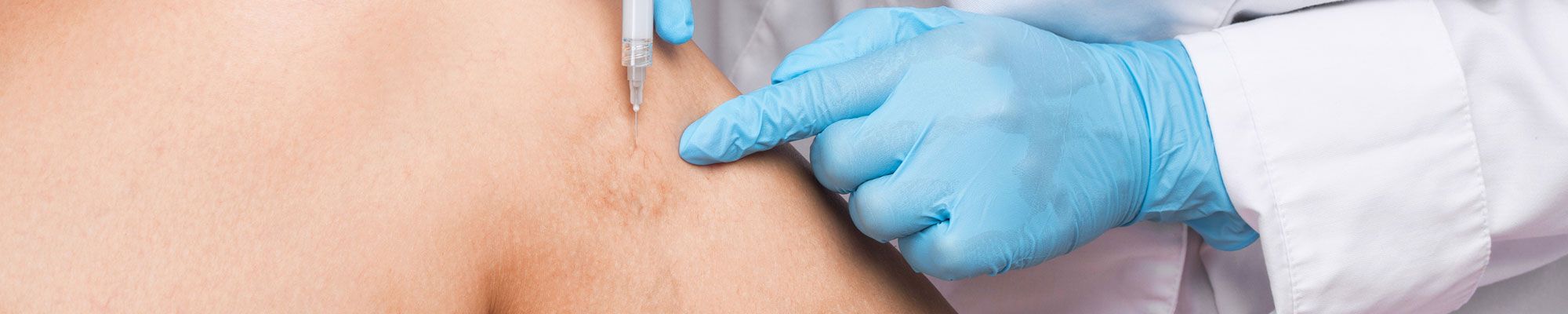 Thread-Veins-Sclerotherapy-Treatment-Main-Feature-Image Thread Veins Sclerotherapy Treatment Main Feature Image