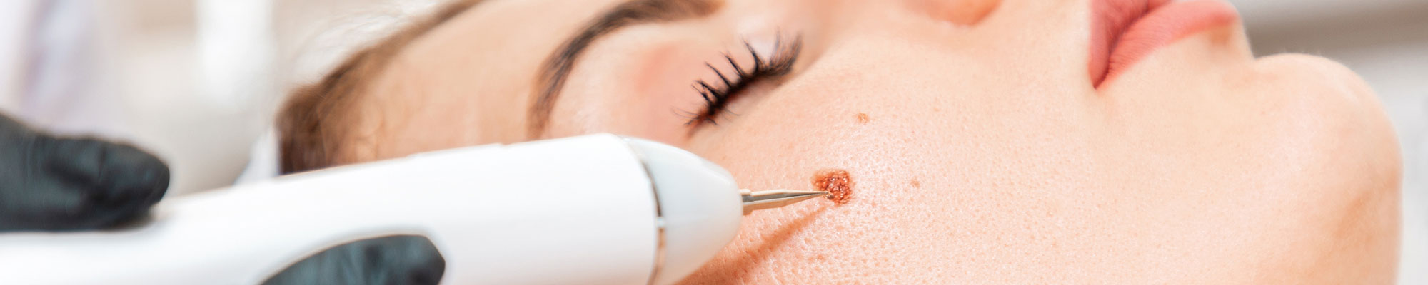 Aesthetic Clinic Moles and Warts Page Main Feature Image