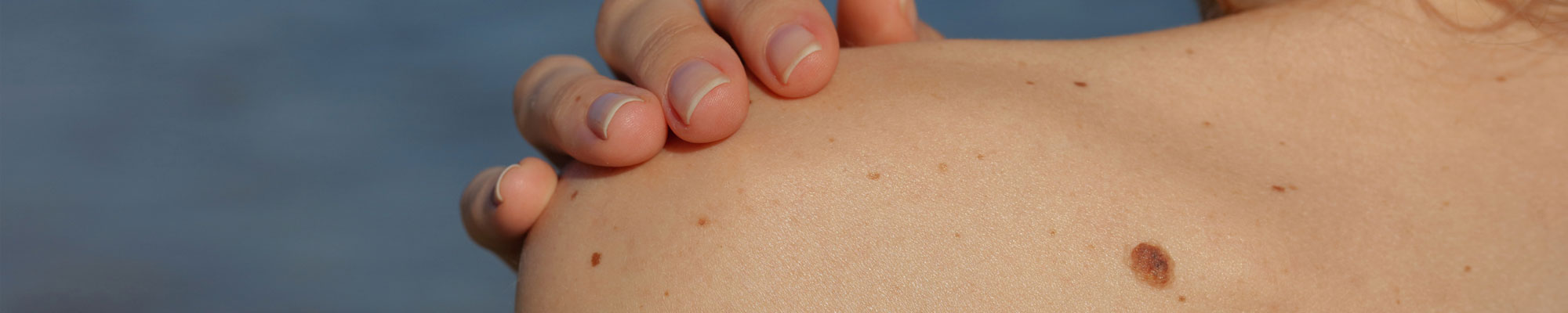 Skin Clinic Milton Keynes Mole Screening Main Feature Image