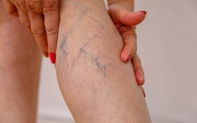 What is sclerotherapy?