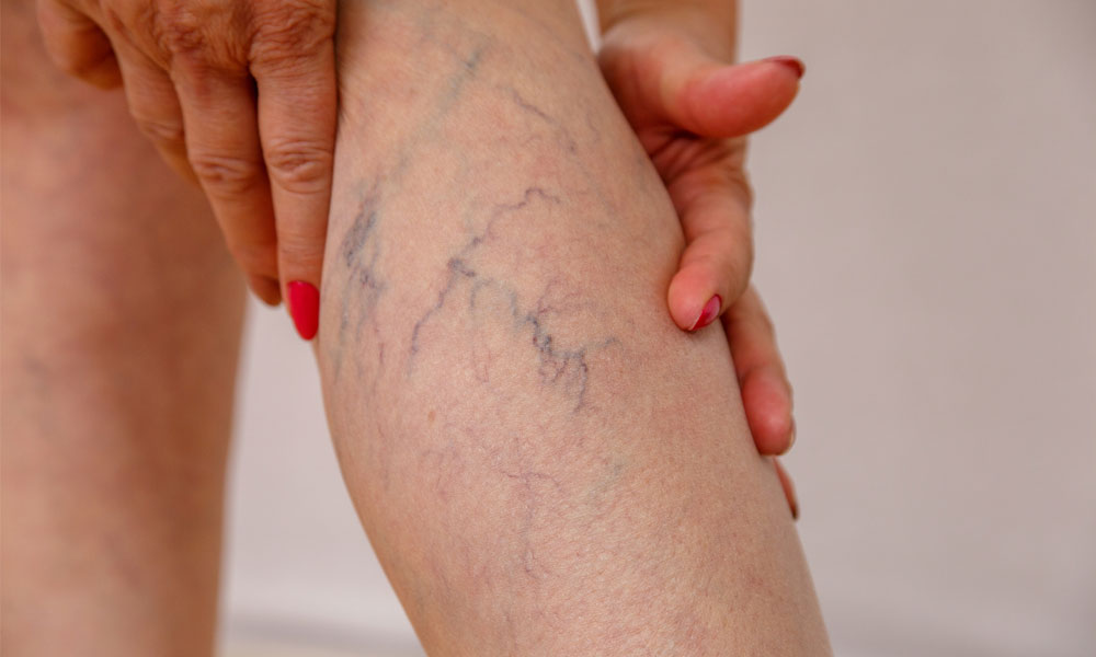 Thread Vein Treatment What is sclerotherapy Blog Image