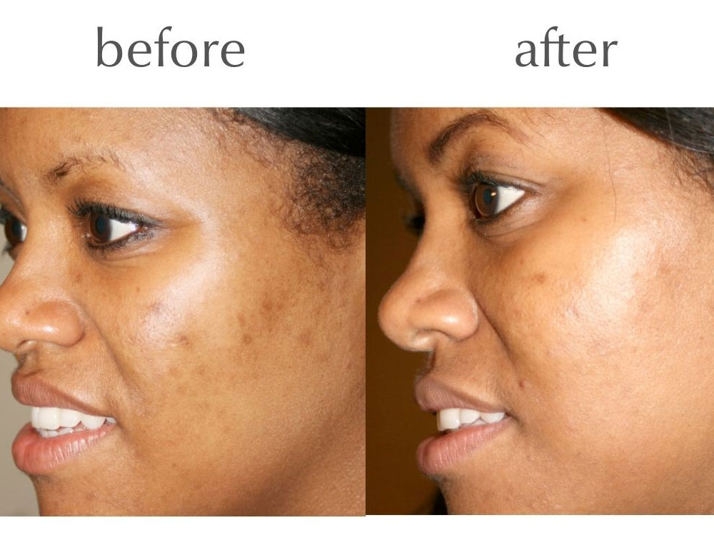 Skin Peels The Perfect Peel Before and After Pic 1
