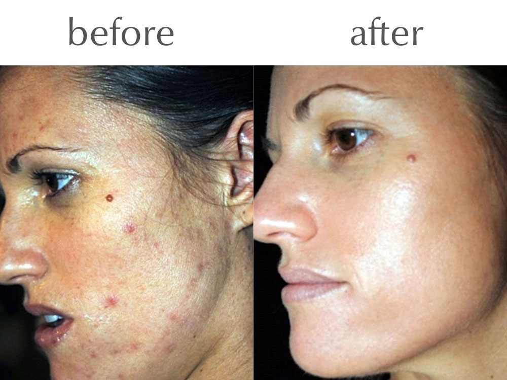 Skin Peels The Perfect Peel Before and After Pic 2