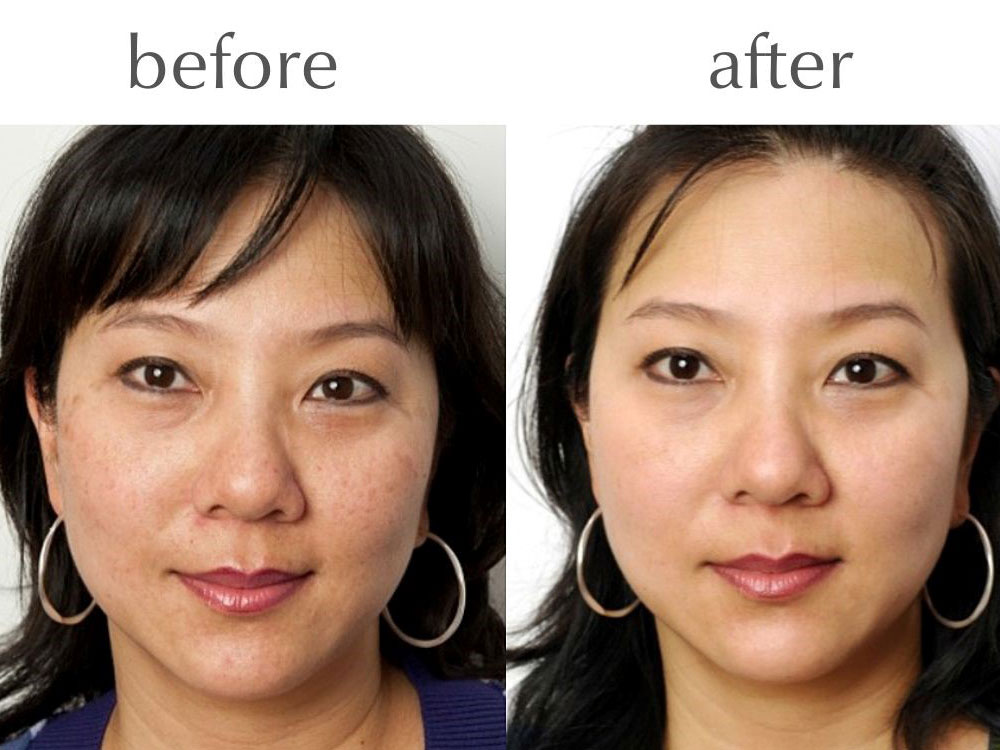 Skin Peels The Perfect Peel Before and After Pic 3