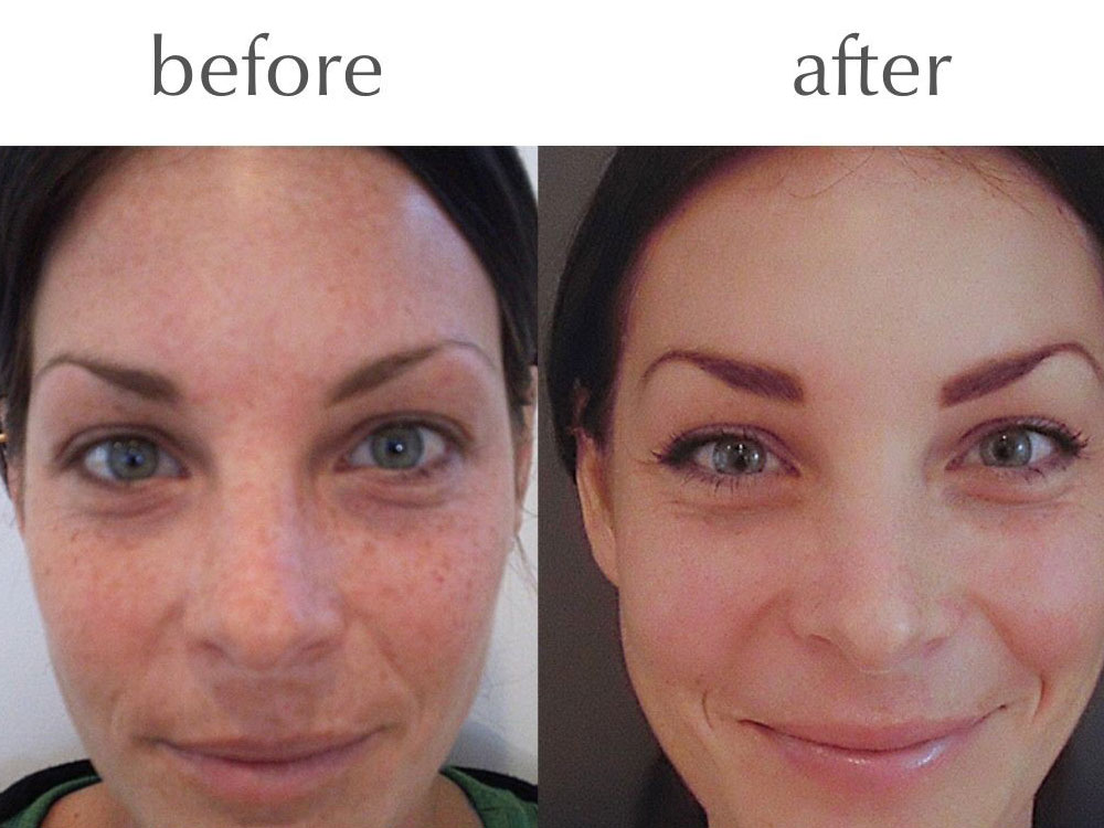 Skin Peels The Perfect Peel Before and After Pic 4