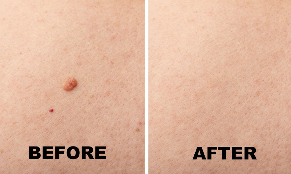 Skin Clinic Milton Keynes Mole Screening Feature Image 3