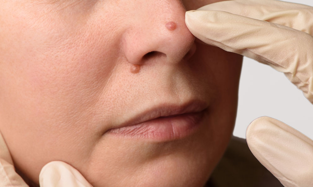 Skin Clinic Milton Keynes Mole Screening Feature Image 4