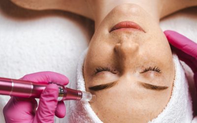 Treating Acne and Acne Scars with Aesthetic Treatments