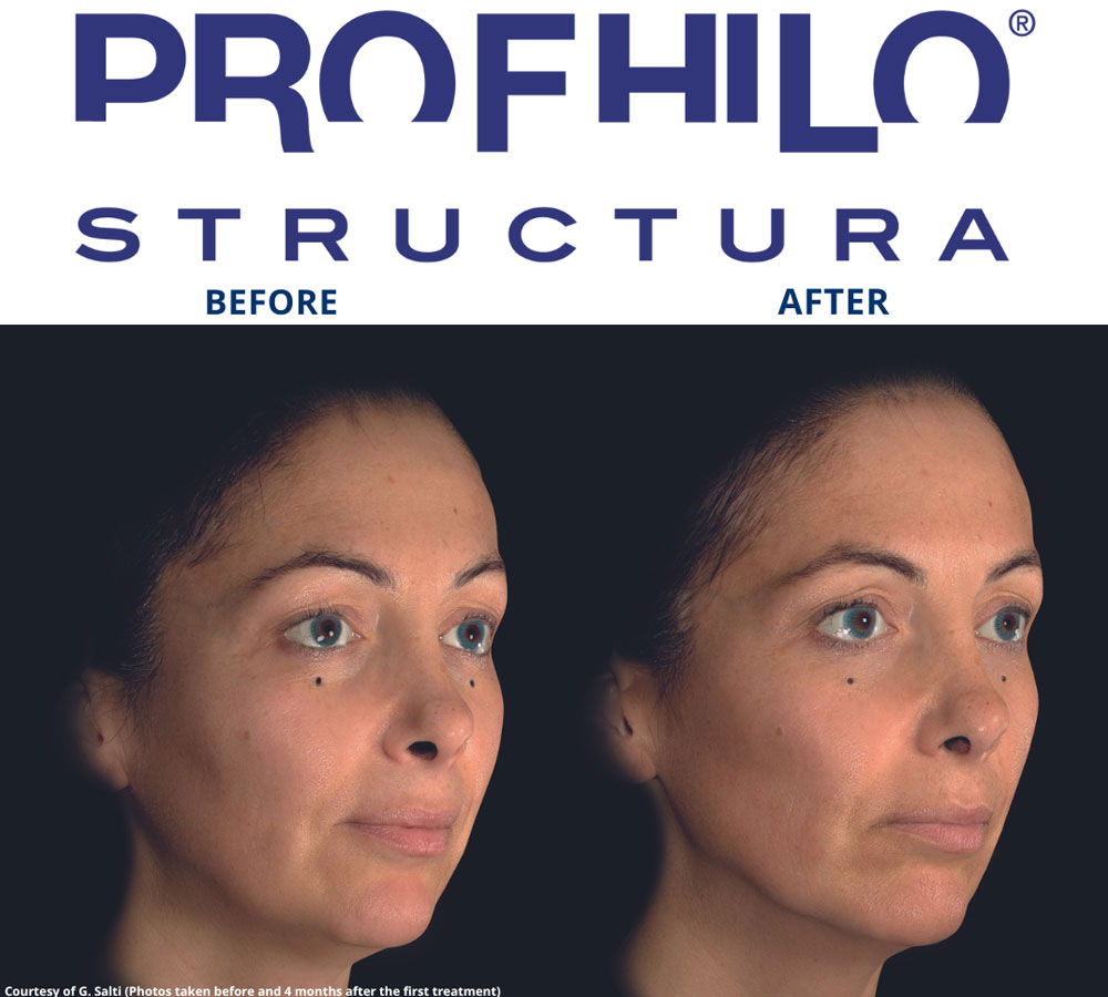 Profhilo-Structura-Feature-Image-2a Profhilo Structura Feature Image 2a