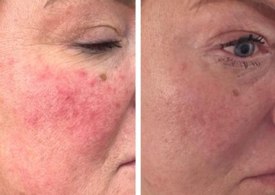 Regenerative Repair Therapy (RRP) Before and After Image 1