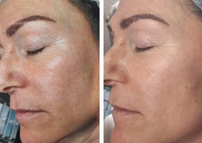 Regenerative Repair Therapy (RRP) Before and After Image 2