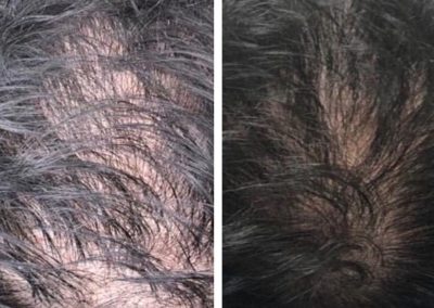 Regenerative Repair Therapy (RRP) Before and After Image 3