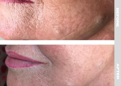 Regenerative Repair Therapy (RRP) Before and After Image 4