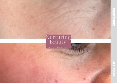 Regenerative Repair Therapy (RRP) Before and After Image 5