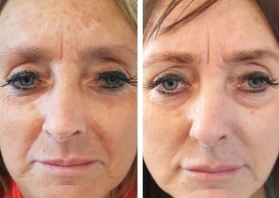 Regenerative Repair Therapy (RRP) Before and After Image 7