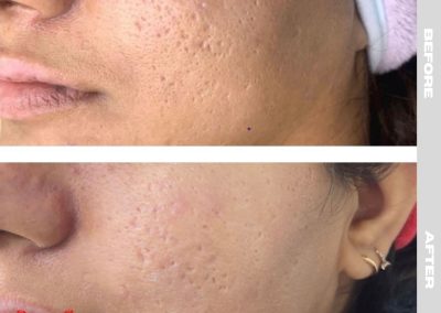 Regenerative Repair Therapy (RRP) Before and After Image 8
