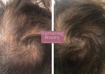 Regenerative Repair Therapy (RRP) Before and After Image 9