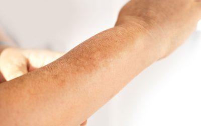 Hyperpigmentation vs Melasma: Understanding Uneven Skin Tone