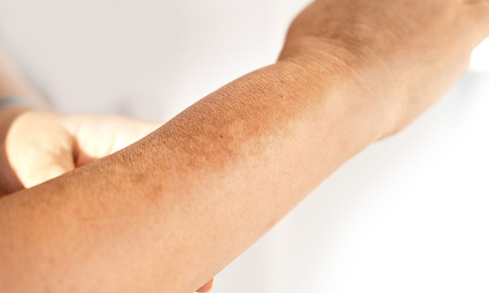 Aesthetic Clinic Hyperpigmentation vs Melasma Understanding Uneven Skin Tone Blog Image