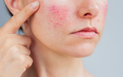 Rosacea and Facial Redness: When Flushing Becomes a Skin Condition