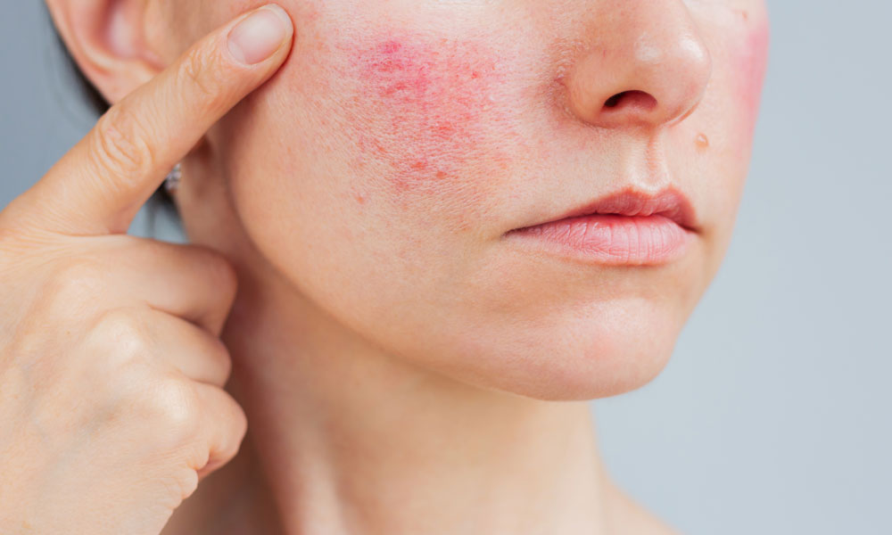Skin Clinic Rosacea and Facial Redness When Flushing Becomes a Skin Condition Blog Image