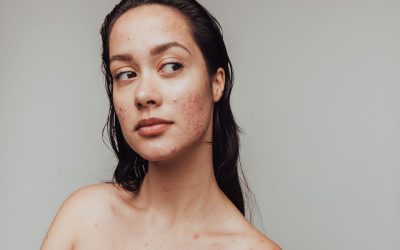 Adult Acne in Your 30s and 40s and Why Breakouts Don’t Always End with Your Teens