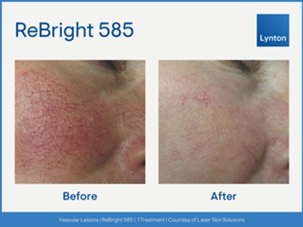 IPL Treatment Skin Nurse Dermatologist Feature Image 1