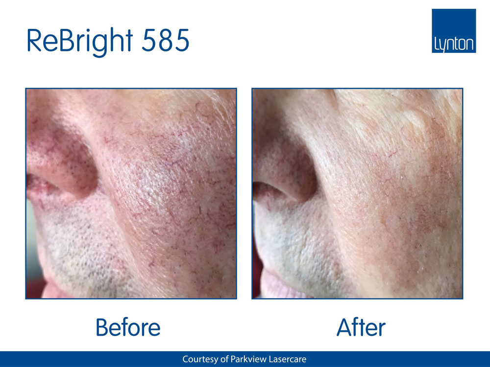 IPL Treatment Skin Nurse Dermatologist Feature Image 2