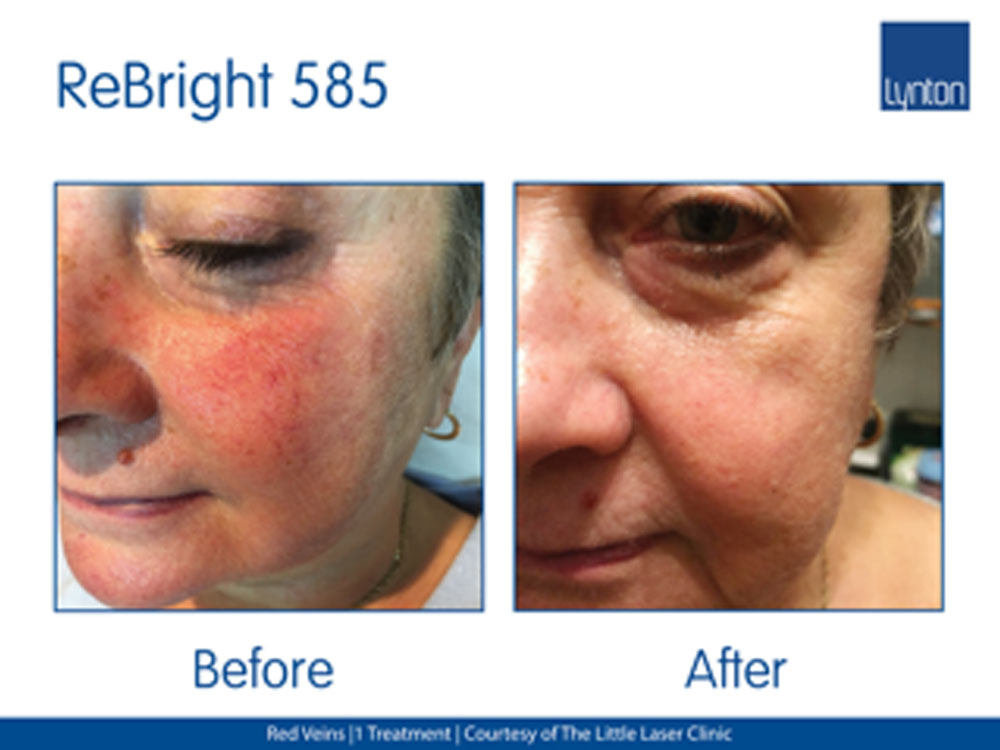 IPL Treatment Skin Nurse Dermatologist Feature Image 3