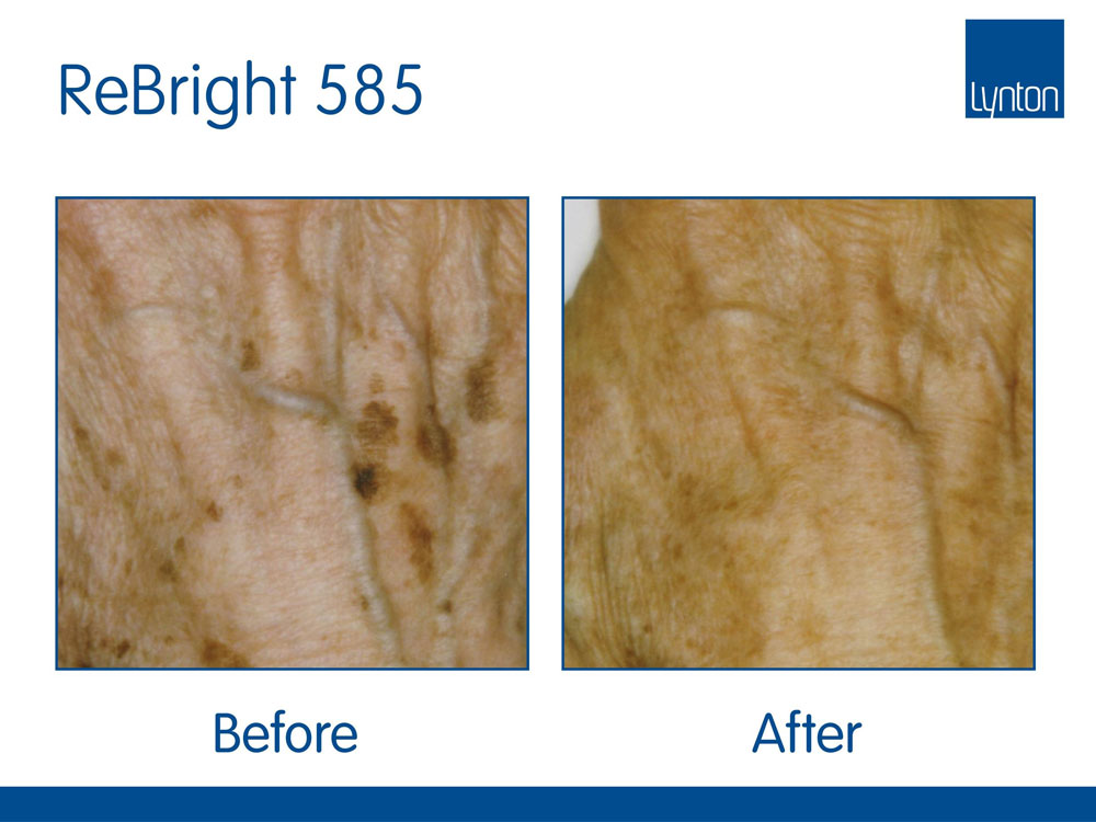 IPL Treatment Skin Nurse Dermatologist Feature Image 4