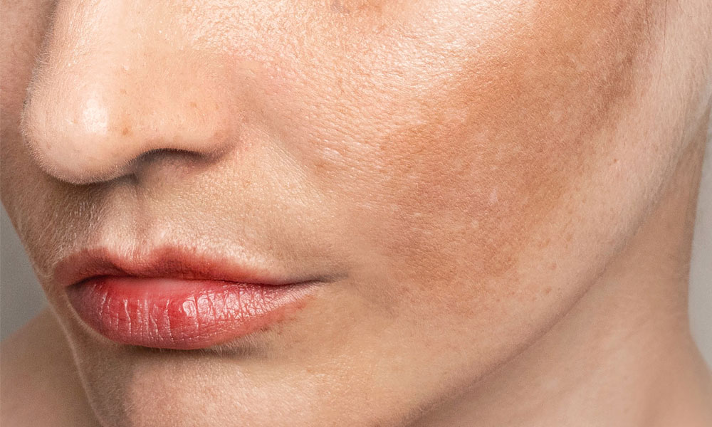 Pigmentation After Pregnancy: Treating Postpartum Melasma Safely