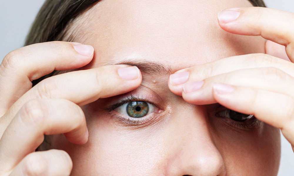 Aesthetic Clinic Safe Removal Options for Milia, Skin Tags and Other Small Bumps Blog Image