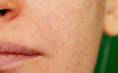 Sun-Damaged Skin: From Freckles to Pigmentation Patches