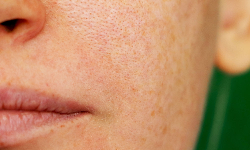 Sun-Damaged Skin: From Freckles to Pigmentation Patches
