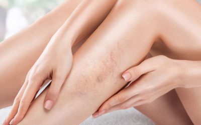 Thread Veins on the Face vs Legs: Different Causes, Different Treatments