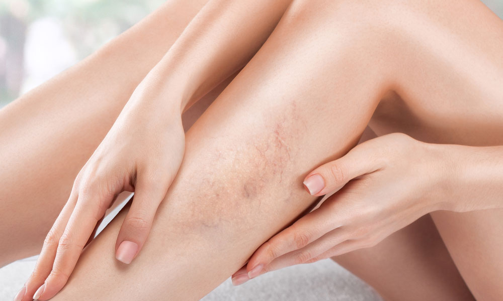 Thread Veins on the Face vs Legs: Different Causes, Different Treatments